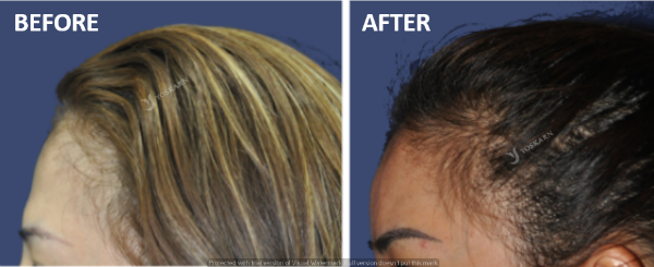 forehead augmentation[3].png (600×245)